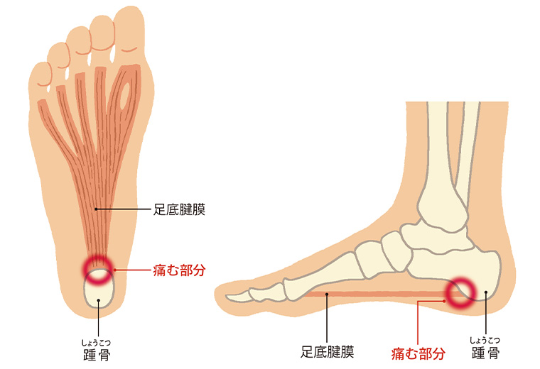 足底腱膜炎の発生箇所