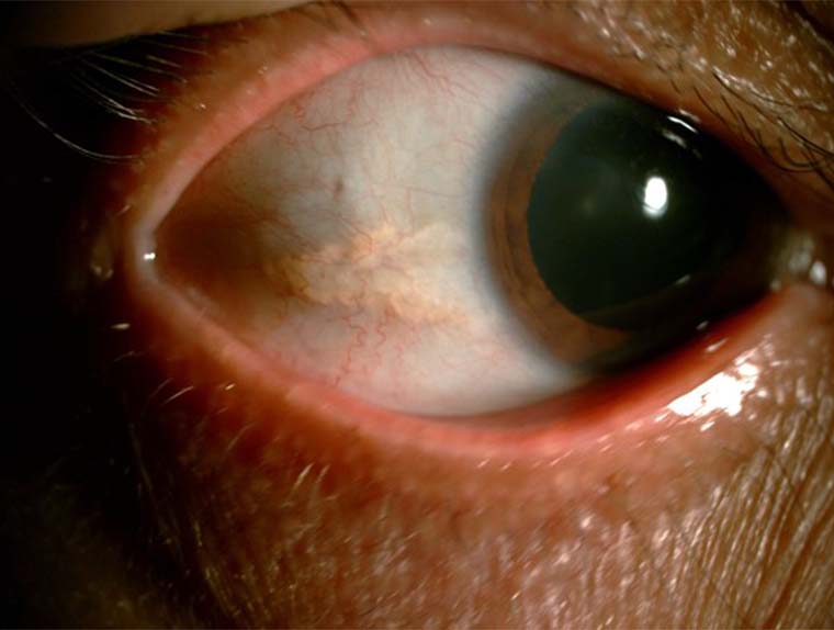 瞼裂斑の写真