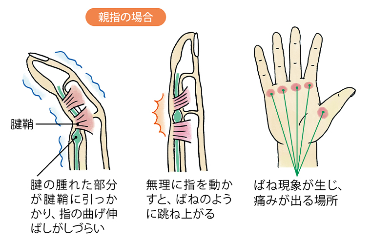 親指の場合 腱の腫れた部分が腱鞘に引っかかり、指の曲げ伸ばしがしづらい。無理に指を動かそうとすると、ばねのように跳ね上がる。ばね現象が生じ、痛みが出る場所。