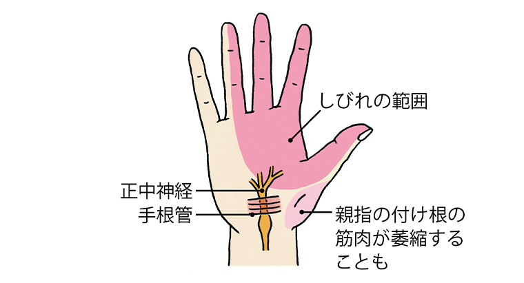しびれの範囲、正中神経、手根管、親指の付け根の筋肉が萎縮することも